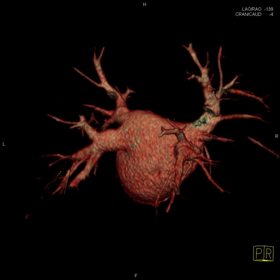 Tomografia lewego przedsionka serca wraz z żyłami płucnymi